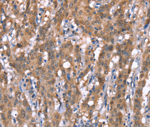 Immunohistochemistry of paraffin-embedded Human gastric cancer tissue using GPC6 Polyclonal Antibody at dilution 1:40