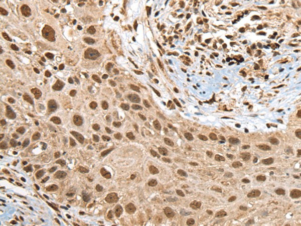 Immunohistochemistry of paraffin-embedded Human lung cancer tissue  using RTCB Polyclonal Antibody at dilution of 1:45(?200)