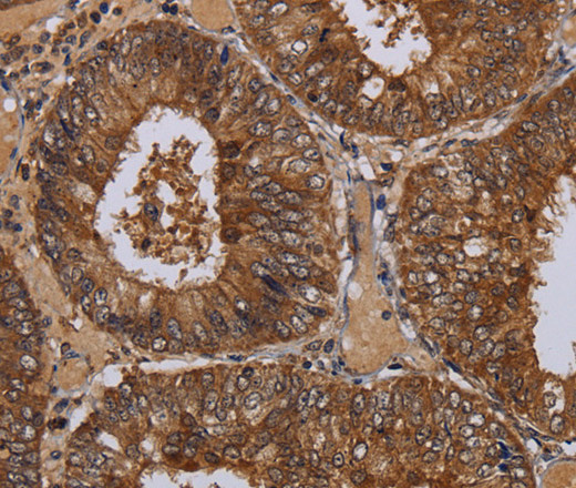 Immunohistochemistry of paraffin-embedded Human colon cancer tissue using WDR83 Polyclonal Antibody at dilution 1:60