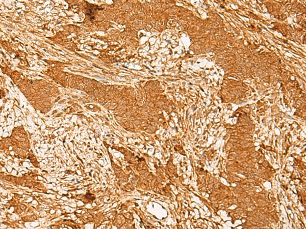 Immunohistochemistry of paraffin-embedded Human ovarian cancer tissue  using GTF3C3 Polyclonal Antibody at dilution of 1:30(?200)