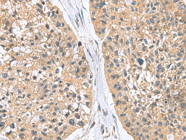 Immunohistochemistry of paraffin-embedded Human esophagus cancer tissue  using RGS2 Polyclonal Antibody at dilution of 1:95(?200)