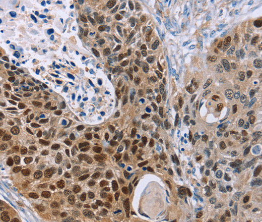 Immunohistochemistry of paraffin-embedded Human esophagus cancer using MAGEA10 Polyclonal Antibody at dilution of 1:30