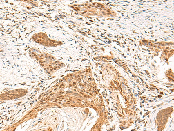 Immunohistochemistry of paraffin-embedded Human esophagus cancer tissue  using TEAD3 Polyclonal Antibody at dilution of 1:50(?200)