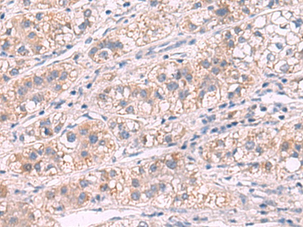 Immunohistochemistry of paraffin-embedded Human liver cancer tissue  using G6PC Polyclonal Antibody at dilution of 1:50(?200)