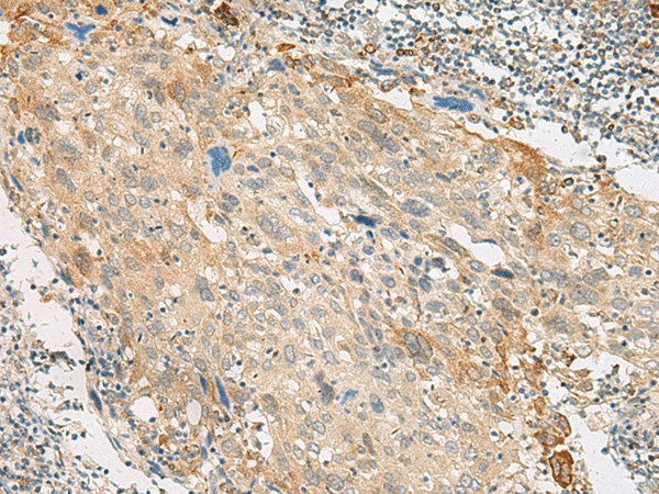 Immunohistochemistry of paraffin-embedded Human cervical cancer tissue  using GPR151 Polyclonal Antibody at dilution of 1:45(?200)