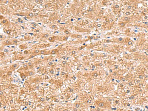 Immunohistochemistry of paraffin-embedded Human liver cancer tissue  using HMGCLL1 Polyclonal Antibody at dilution of 1:70(?200)