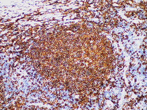 Immunohistochemistry of paraffinembedded Human tonsil tissue with CD20 Monoclonal Antibody(Antigen repaired by EDTA).