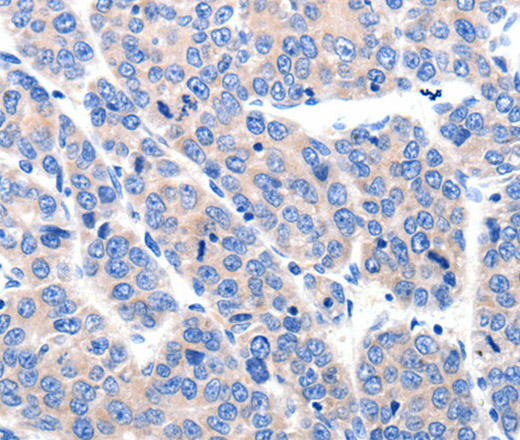 Immunohistochemistry of paraffin-embedded Human ovarian cancer tissue using KCNH8 Polyclonal Antibody at dilution 1:50