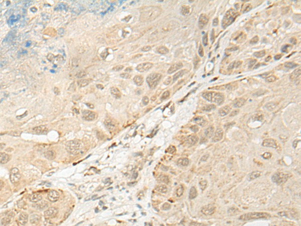 Immunohistochemistry of paraffin-embedded Human esophagus cancer tissue  using OTX1 Polyclonal Antibody at dilution of 1:30(?200)