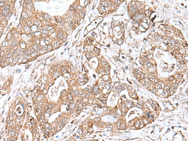 Immunohistochemistry of paraffin-embedded Human gastric cancer tissue  using TEAD2 Polyclonal Antibody at dilution of 1:60(?200)