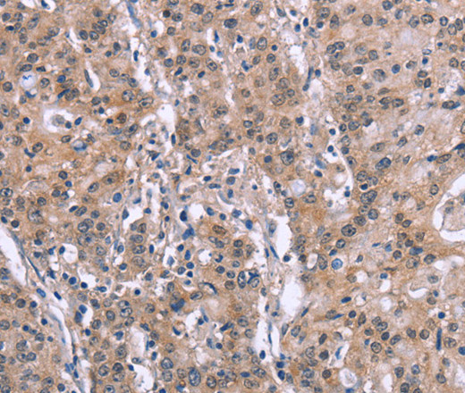 Immunohistochemistry of paraffin-embedded Human gastric cancer tissue using GPR172B Polyclonal Antibody at dilution 1:40