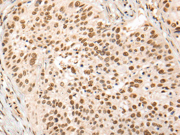 Immunohistochemistry of paraffin-embedded Human lung cancer tissue  using HOXA7 Polyclonal Antibody at dilution of 1:70(?200)