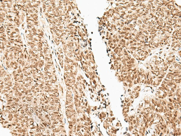 Immunohistochemistry of paraffin-embedded Human ovarian cancer tissue  using FUT3 Polyclonal Antibody at dilution of 1:35(?200)