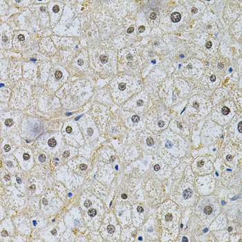 Immunohistochemistry of paraffin-embedded Human liver damage using SQSTM1 / p62 Polyclonal Antibody at dilution of 1:200 (40x lens).