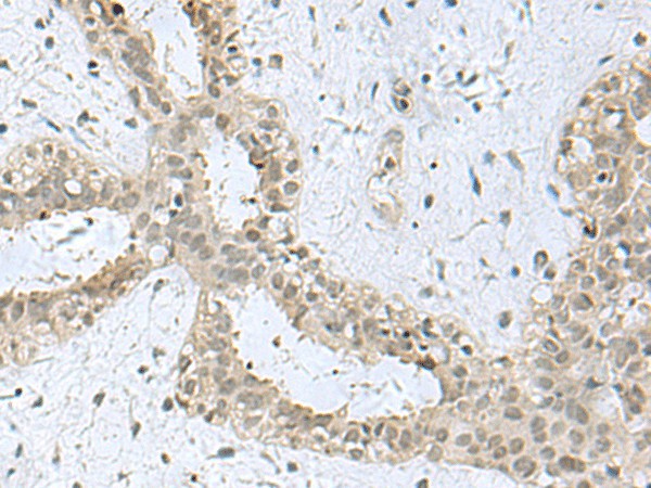 Immunohistochemistry of paraffin-embedded Human breast cancer tissue  using KDM3B Polyclonal Antibody at dilution of 1:40(?200)