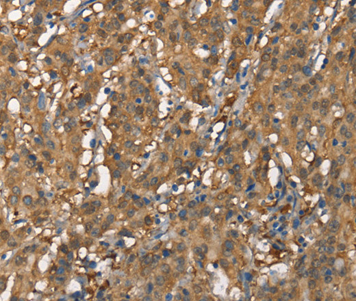 Immunohistochemistry of paraffin-embedded Human gastric cancer tissue using CDC25A Polyclonal Antibody at dilution 1:60