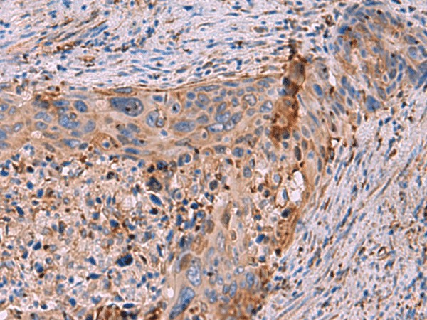 Immunohistochemistry of paraffin-embedded Human cervical cancer tissue  using KBTBD11 Polyclonal Antibody at dilution of 1:35(?200)