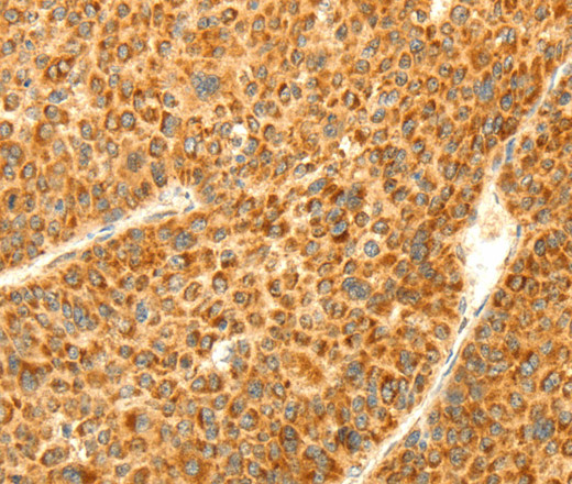 Immunohistochemistry of paraffin-embedded Human liver cancer using DIABLO Polyclonal Antibody at dilution of 1:70