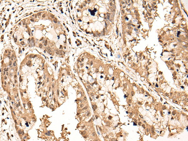 Immunohistochemistry of paraffin-embedded Human liver cancer tissue  using ATAD3A Polyclonal Antibody at dilution of 1:40(?200)