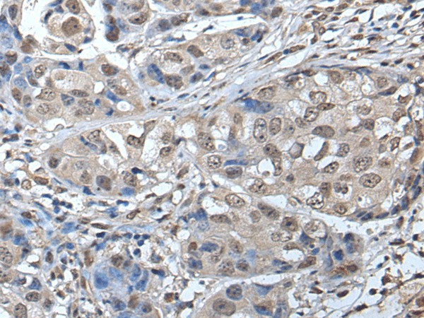 Immunohistochemistry of paraffin-embedded Human breast cancer tissue  using SMC1A Polyclonal Antibody at dilution of 1:45(?200)