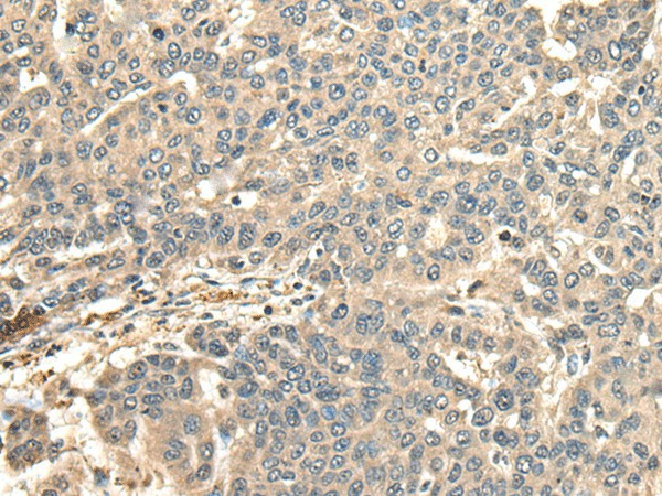 Immunohistochemistry of paraffin-embedded Human liver cancer tissue  using CCDC113 Polyclonal Antibody at dilution of 1:65(?200)