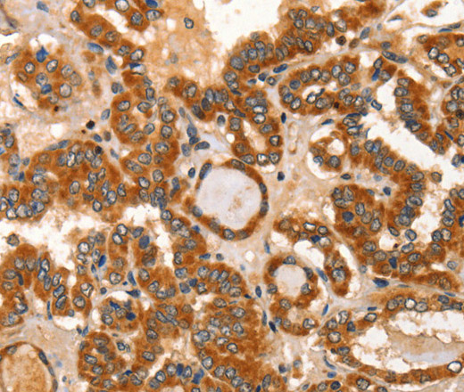 Immunohistochemistry of paraffin-embedded Human thyroid cancer tissue using IKZF3 Polyclonal Antibody at dilution 1:60