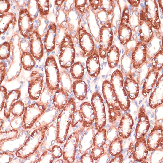 Immunohistochemistry of paraffin-embedded human liver cancer using MARK3 Polyclonal Antibody at dilution of 1:100 (40x lens).Perform microwave antigen retrieval with 10 mM PBS buffer pH 7.2 before commencing with IHC staining protocol.