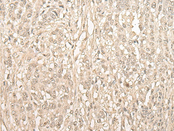 Immunohistochemistry of paraffin-embedded Human ovarian cancer tissue  using FYTTD1 Polyclonal Antibody at dilution of 1:30(?200)