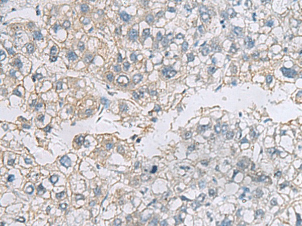 Immunohistochemistry of paraffin-embedded Human liver cancer tissue  using VEGFA Polyclonal Antibody at dilution of 1:45(?200)