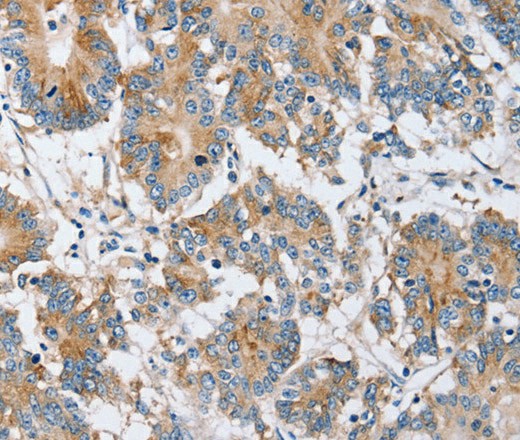 Immunohistochemistry of paraffin-embedded Human colon cancer using PPM1F Polyclonal Antibody at dilution of 1:40