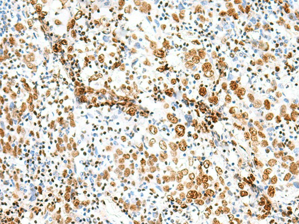 Immunohistochemistry of paraffin-embedded Human cervical cancer tissue  using TCOF1 Polyclonal Antibody at dilution of 1:50(?200)