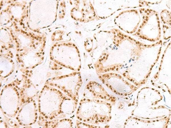 Immunohistochemistry of paraffin-embedded Human thyroid cancer tissue  using TCOF1 Polyclonal Antibody at dilution of 1:50(?200)