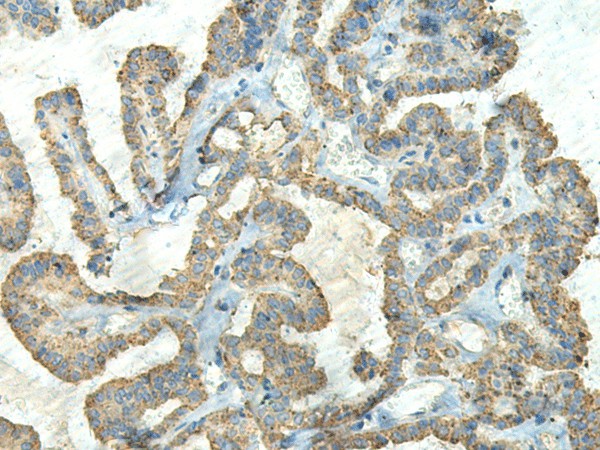 Immunohistochemistry of paraffin-embedded Human thyroid cancer tissue  using FCGRT Polyclonal Antibody at dilution of 1:65(?200)