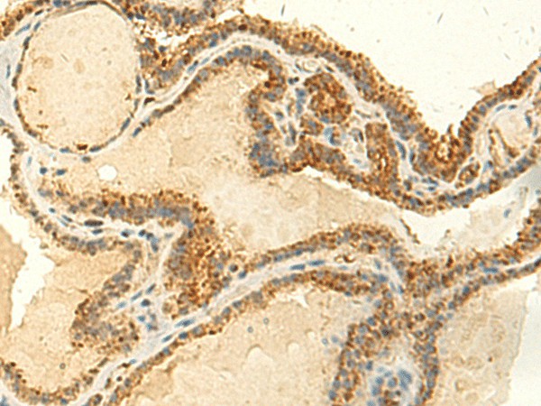 Immunohistochemistry of paraffin-embedded Human thyroid cancer tissue  using MTHFS Polyclonal Antibody at dilution of 1:50(?200)