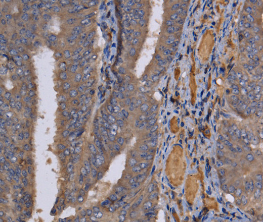 Immunohistochemistry of paraffin-embedded Human colon cancer using REG3G Polyclonal Antibody at dilution of 1:60