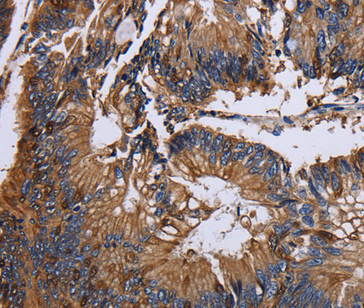 Immunohistochemistry of paraffin-embedded Human colon cancer using KRT31 Polyclonal Antibody at dilution of 1:30