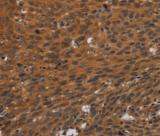 Immunohistochemistry of paraffin-embedded Human cervical cancer tissue using PNOC Polyclonal Antibody at dilution 1:40