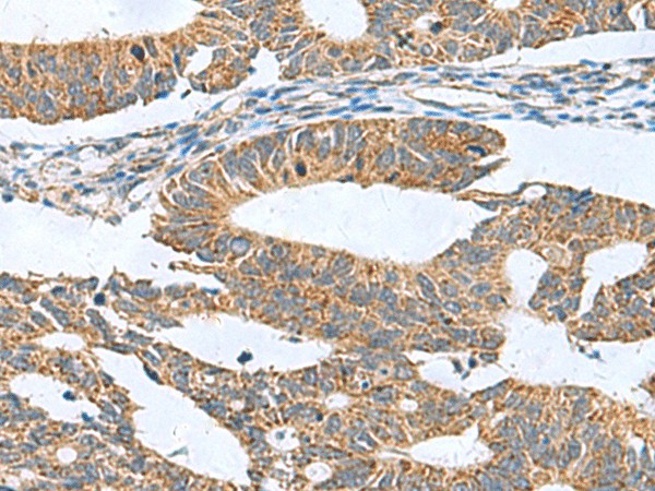 Immunohistochemistry of paraffin-embedded Human colorectal cancer tissue  using CLEC1B Polyclonal Antibody at dilution of 1:60(?200)