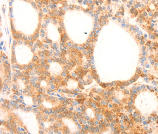 Immunohistochemistry of paraffin-embedded Human thyroid cancer using NAP1L1 Polyclonal Antibody at dilution of 1:70