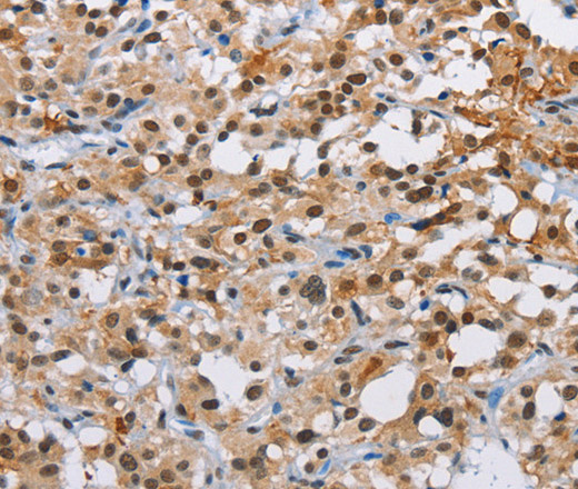 Immunohistochemistry of paraffin-embedded Human thyroid cancer using ATXN1 Polyclonal Antibody at dilution of 1:40