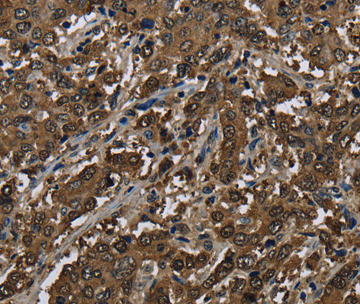 Immunohistochemistry of paraffin-embedded Human liver cancer using GSTP1 Polyclonal Antibody at dilution of 1:60