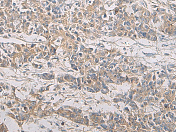 Immunohistochemistry of paraffin-embedded Human colorectal cancer tissue  using PA2G4 Polyclonal Antibody at dilution of 1:60(?200)