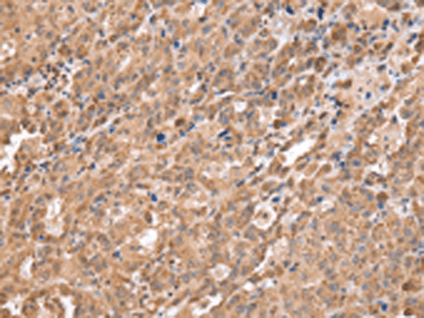 Immunohistochemistry of paraffin-embedded Human ovarian cancer tissue  using DDX58 Polyclonal Antibody at dilution of 1:40(?200)