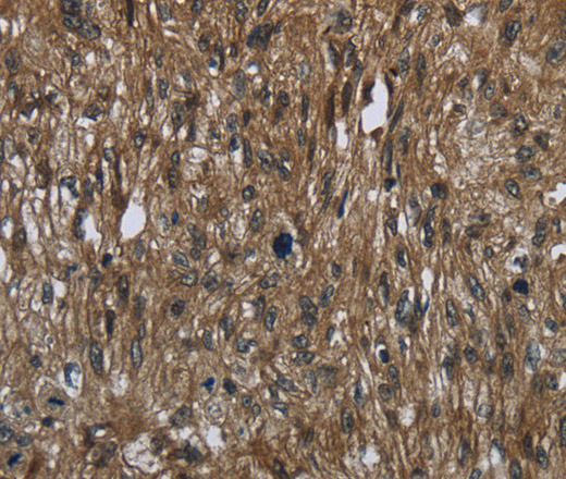 Immunohistochemistry of paraffin-embedded Human esophagus cancer tissue using FASTKD2 Polyclonal Antibody at dilution 1:50