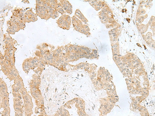 Immunohistochemistry of paraffin-embedded Human liver cancer tissue  using PSMA4 Polyclonal Antibody at dilution of 1:50(?200)