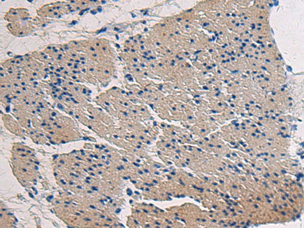 Immunohistochemistry of paraffin-embedded Human gastric cancer tissue  using COL17A1 Polyclonal Antibody at dilution of 1:50(?200)