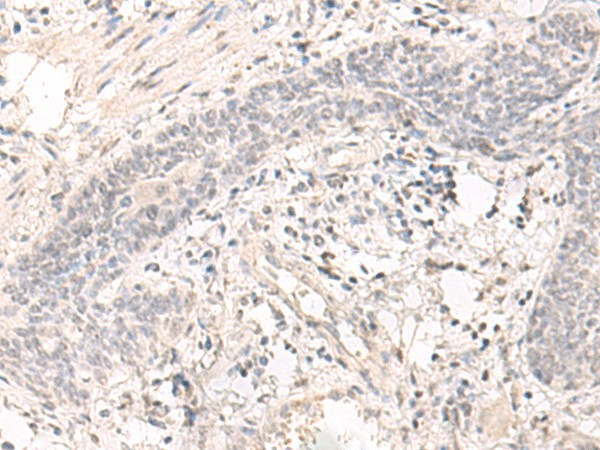 Immunohistochemistry of paraffin-embedded Human esophagus cancer tissue  using SAP130 Polyclonal Antibody at dilution of 1:35(?200)