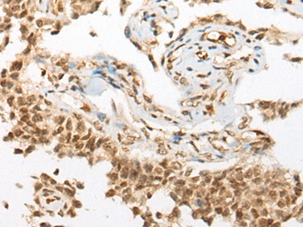 Immunohistochemistry of paraffin-embedded Human ovarian cancer tissue  using ATN1 Polyclonal Antibody at dilution of 1:50(?200)