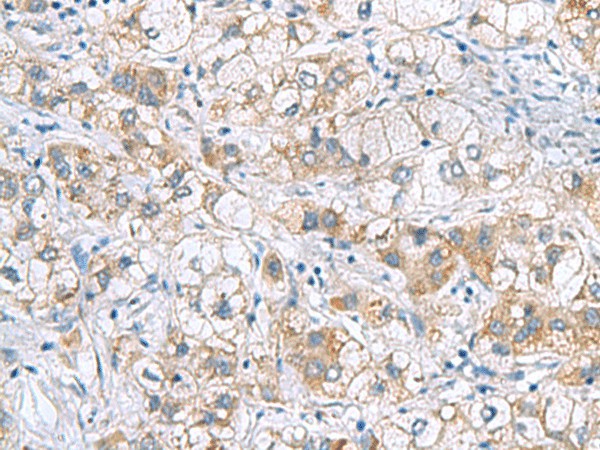 Immunohistochemistry of paraffin-embedded Human liver cancer tissue  using GCSH Polyclonal Antibody at dilution of 1:60(?200)