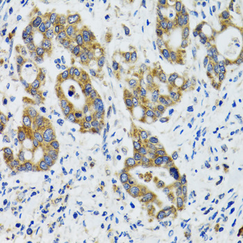 Immunohistochemistry of paraffin-embedded Human colon carcinoma using HYOU1 Polyclonal Antibody at dilution of 1:100 (40x lens).